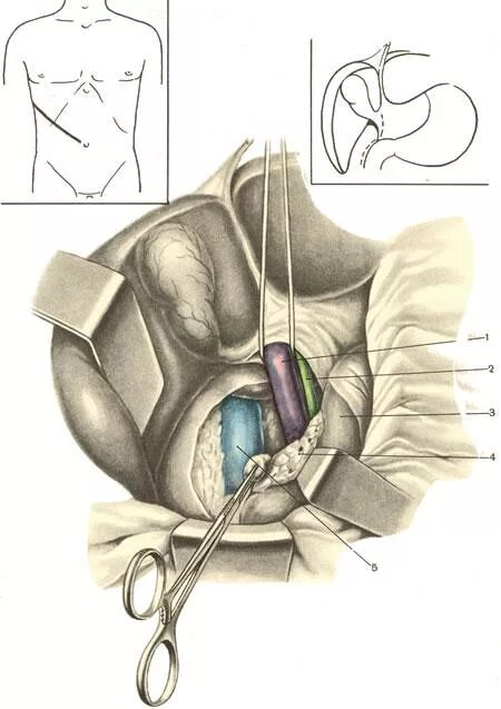 Портокавальный анастомоз операция. Атлас операций на брюшной полости. Операции на желчных протоках. Анастомоз желчного протока. Операция 5 7 это