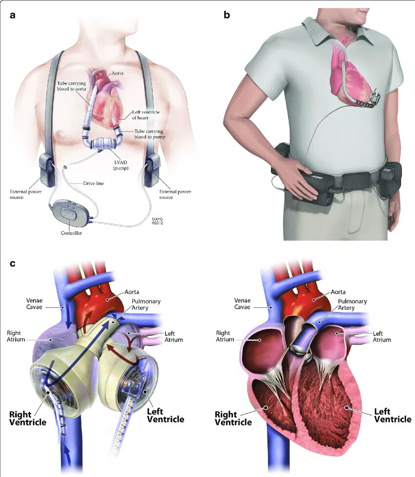 Искусственный желудочек сердца. Искусственный левый желудочек сердца операция. Искусственное сердце аппарат. Насос для искусственного сердца.