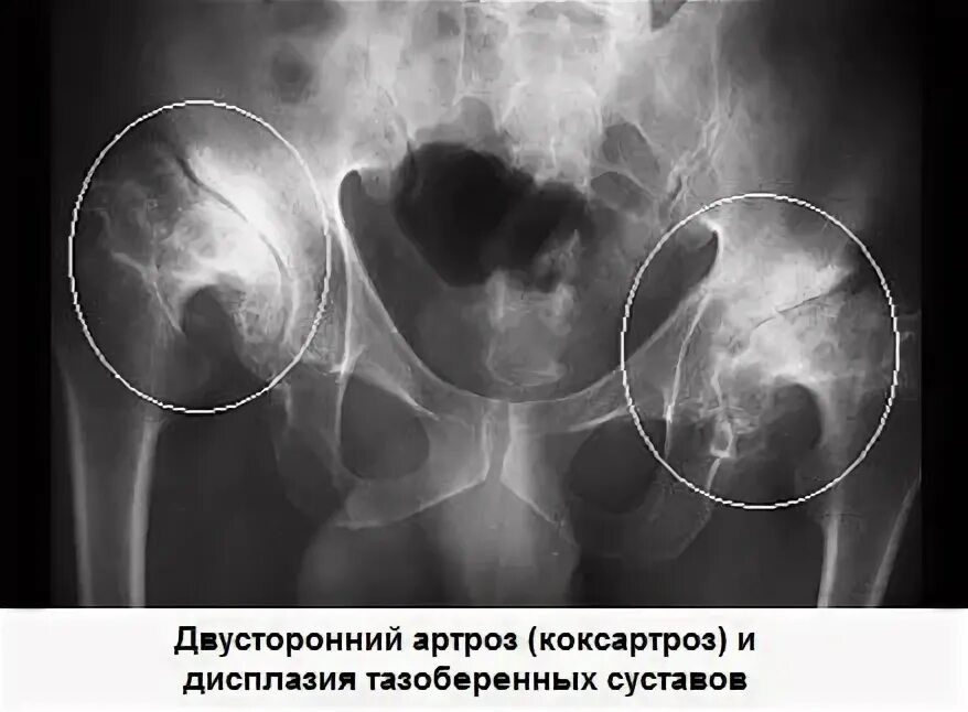 Метастазы в тазобедренном суставе. Опухоли тазобедренного сустава на рентгене. метастазы в тазобедренном суставе рентген. патология тазобедренного сустава на рентгене. воспаление тазобедренного сустава рентген.