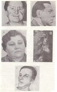 Лицо гиппократа