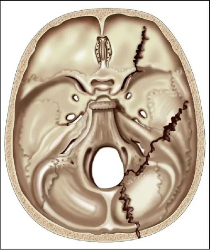 Для перелома основания черепа характерно. Перелом свода основания черепа. Симптомы перелома средней черепной ямки. Черепно мозговая травма перелом основания черепа. Переломы основания черепа передней черепной ямки.