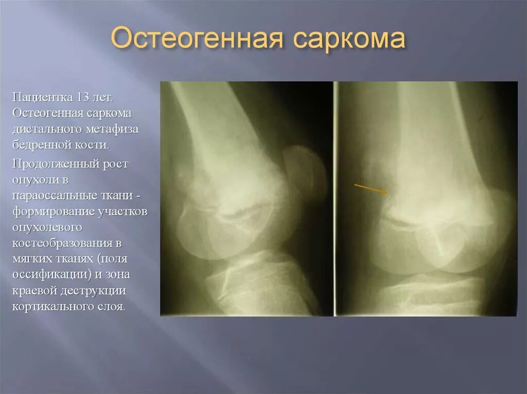 Рак кости симптомы лечение - найдено 90 картинок
