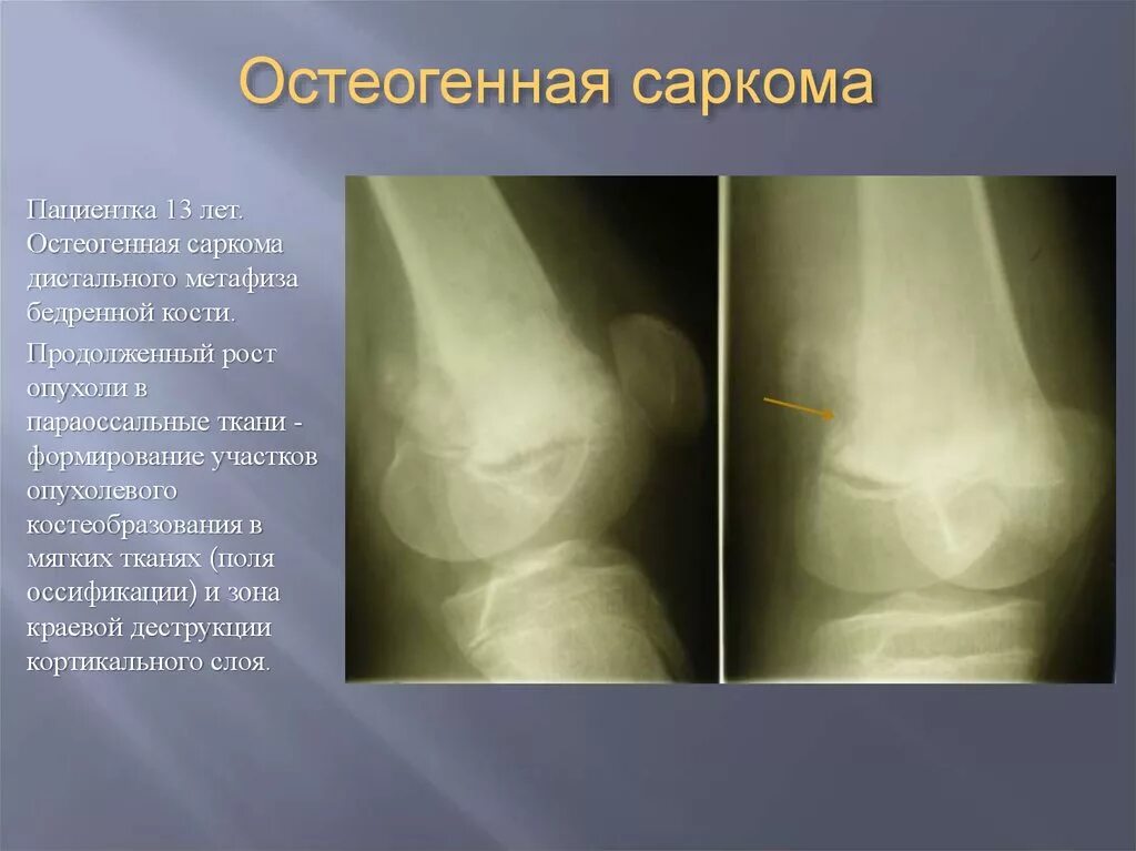 Диагноз саркома. Остеогенная остеолитическая саркома. Остеосаркома остеобластическая форма. Остеосаркома метафиза бедренной кости. Симптомы остеосаркомы бедренной кости.