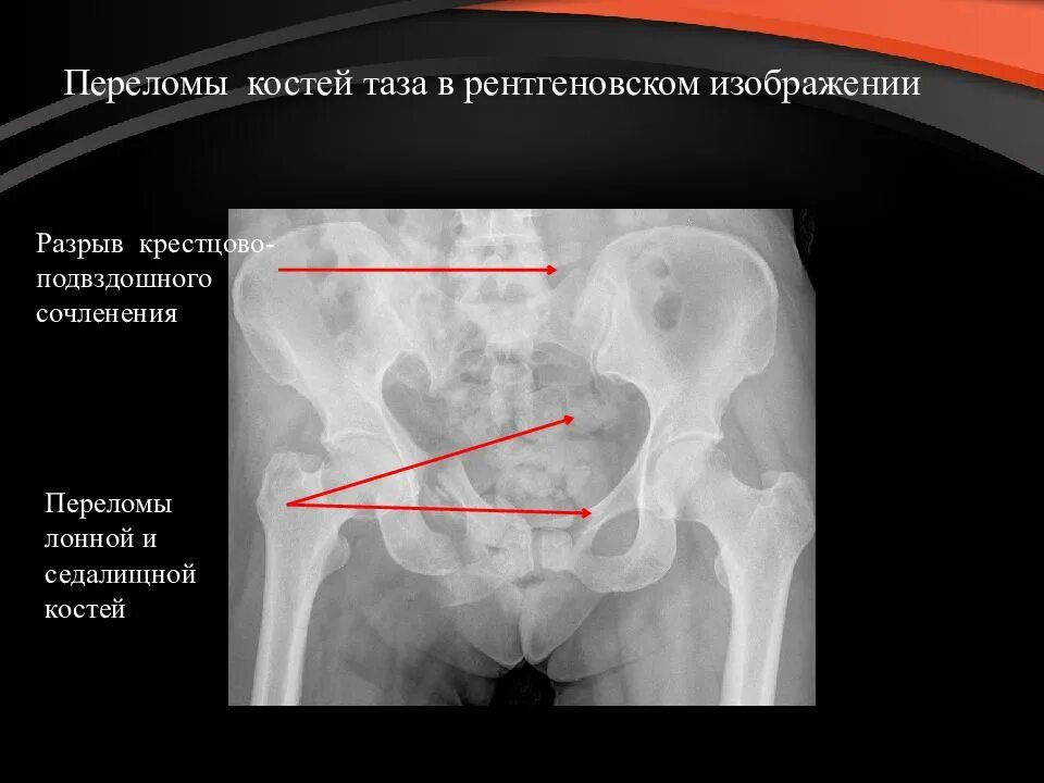 Перелом седалищной и лонной кости рентген. Перелом лобковой кости таза рентген. Перелом крестца и лонной кости. Перелом нижней ветви левой лонной кости.