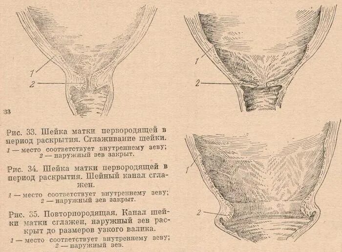 Маточный зев. Открытие наружного зева при беременности. Внутренний маточный зев при беременности. Раскрытие шейки матки. Наружный и внутренний зев матки.