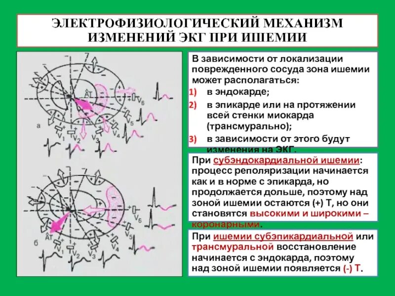 Зона ишемии. ЭКГ механизм. Изменения ЭКГ при ишемии. Электрофизиологические механизмы ишемии.