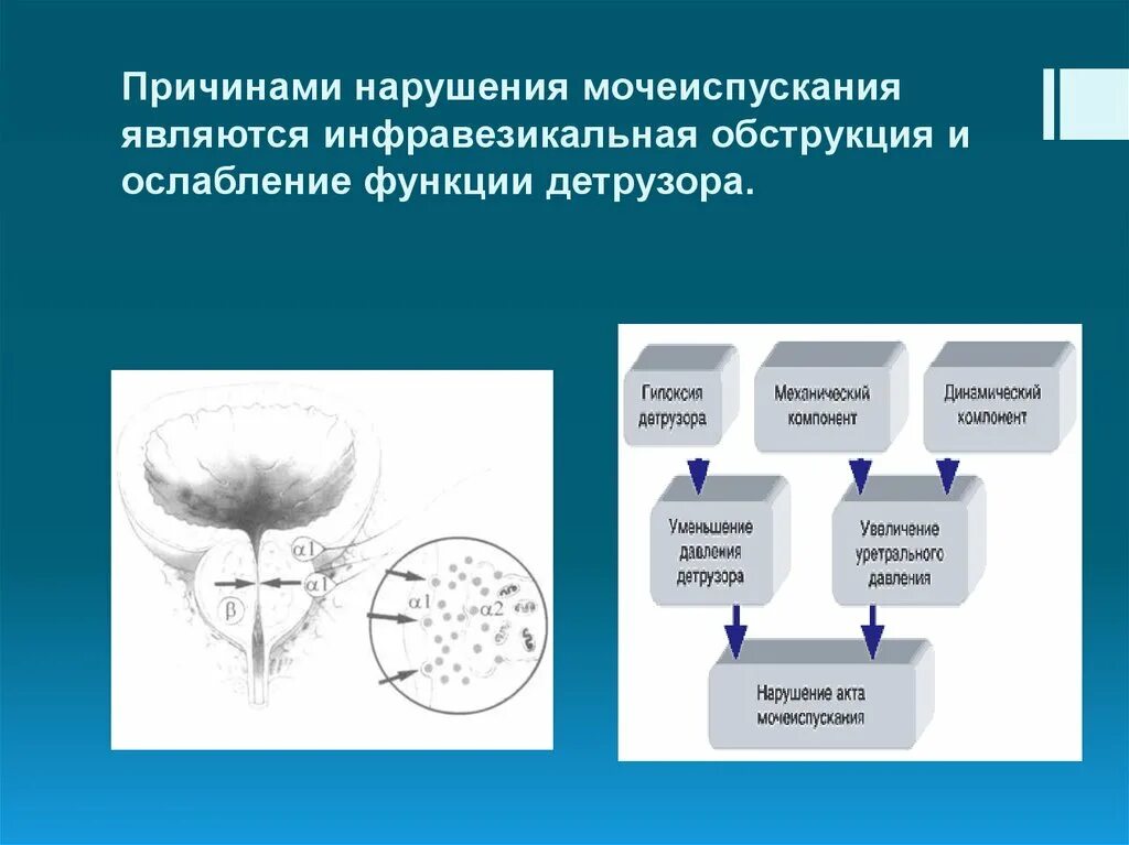 Патологии мочеиспускания. Инфравезикальная обструкция. Синдром инфравезикальной обструкции. Причины инфравезикальной обструкции.