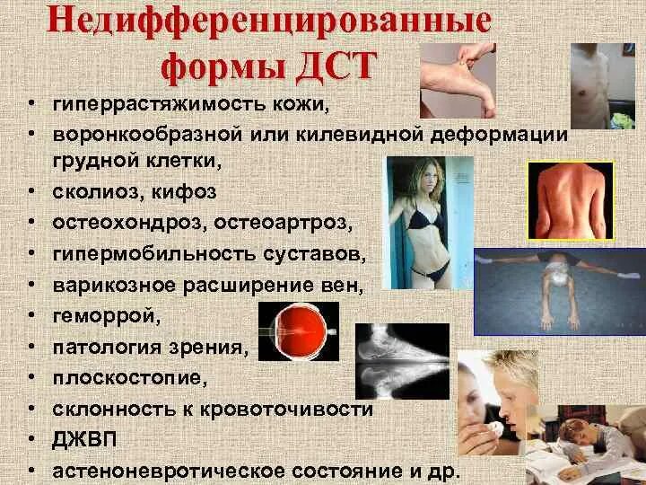 Дисплазия соединительной ткани - Арт Минск.ру