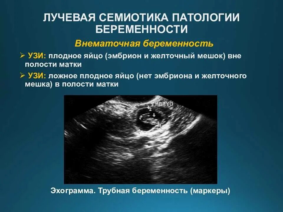 Как отличить на узи. Внематочная Трубная беременность УЗИ. Внематочная беременность на УЗИ. Трубная беременность УЗИ. УЗИ внематочной беременности на раннем сроке.