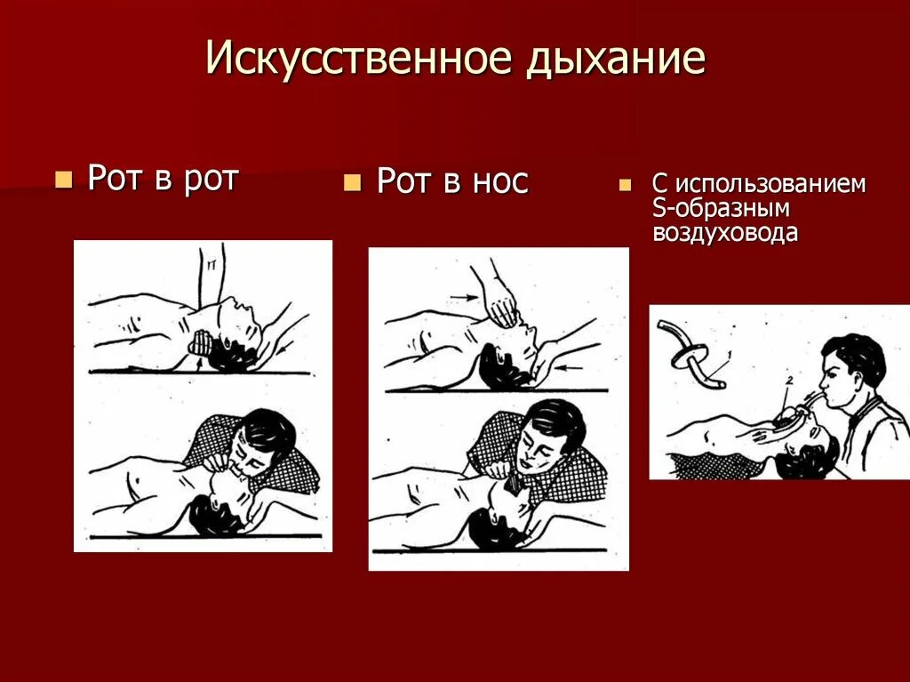 Назовите основные виды неаппаратных способов искусственного дыхания