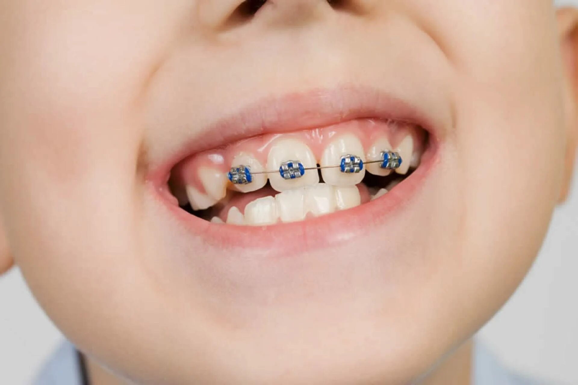 Ребенку 2 года 12 зубов. Частичная брекет-система 2x4. Частичная брекет система 2 на 4.