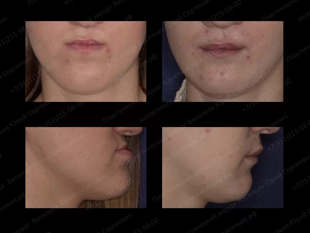 Липофилинг верхней губы. Липофилинг губ до и после. Липофилинг губ гришкян. Липофилинг верхней губы. Липофилинг губ до и после.