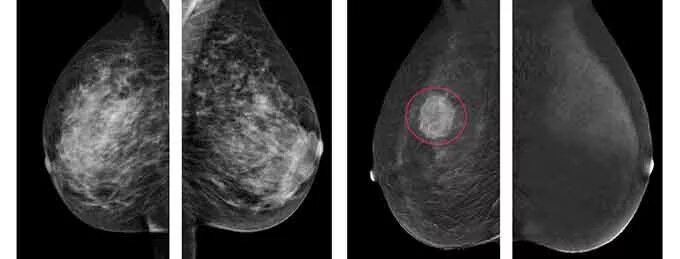 Маммография обязательно. Снимки маммографии молочных желез в норме. Маммография молочной железы норма у женщин. Контрастная спектральная маммография. Опухоль молочной железы маммограмма.