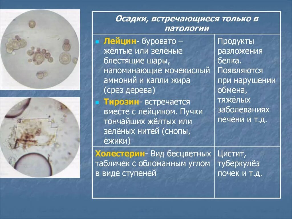 Организованный и неорганизованный осадок мочи. Организованные осадки мочи. Микроскопия осадков мочи. Организованный осадок мочи под микроскопом.