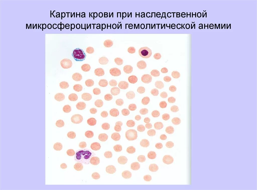 Мазок крови при выявлении патологии что это. Гемолитическая анемия картина крови. Картина крови при наследственной гемолитической анемии. Гемолитическая анемия картина крови показатели. Микросфероцитарная анемия картина крови.