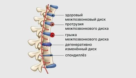 Позвоночный синдром при остеохондрозе