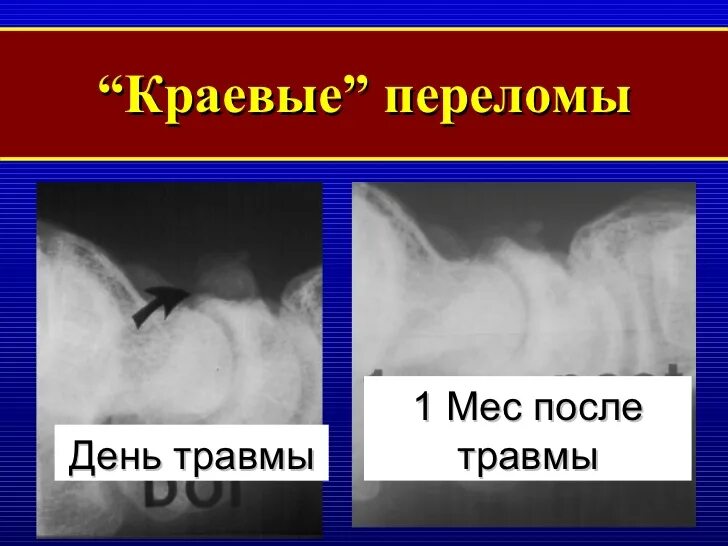 Перелом луча в типичном месте мкб. Закрытый краевой перелом. что означает краевой перелом. гематомы при переломах луча. одной из разновидностей краевого перелома является.