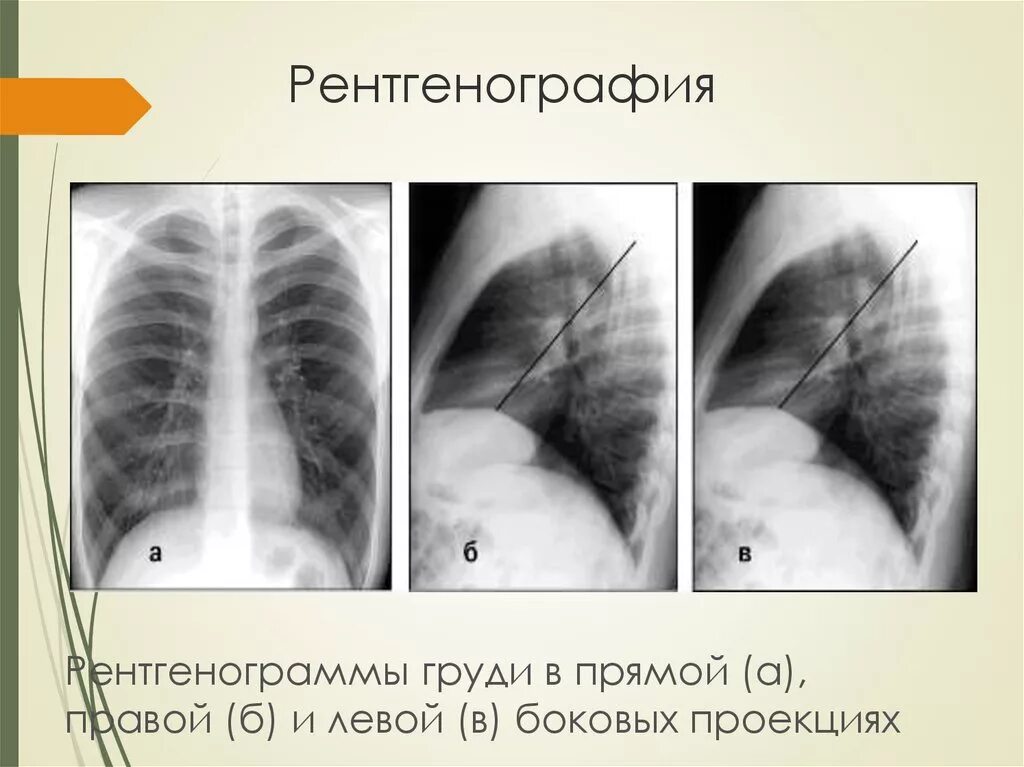 Пневмония рентген боковая проекция. Рентгенограмма грудной клетки в прямой проекции. Легкие в норме (в прямой и боковой проекциях). Боковая проекция легких на рентгене. Легкие в прямой проекции