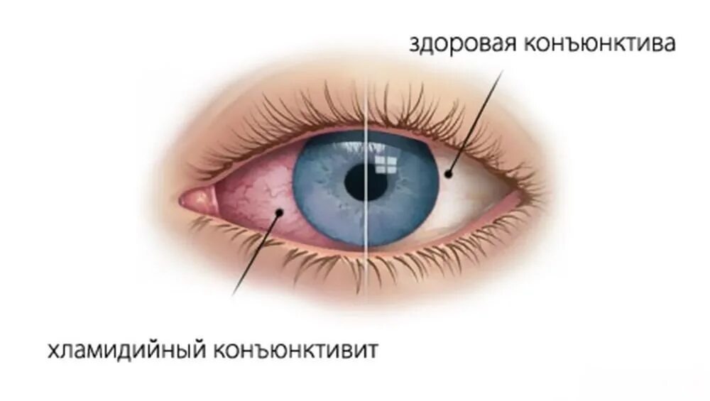 Глазной конъюнктивит лечение. Симптомы хламидийного конъюнктивита. Хламидийный конъюнктивит трахома. Герпесный конъюнктивит. Фликтенулезный конъюнктивит.