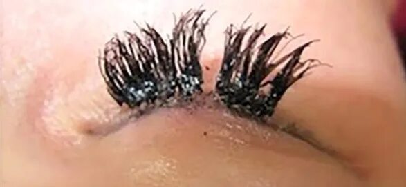 Blepharitis - NHS