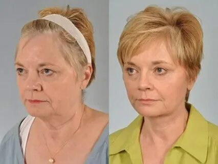 Мезотерапия после 50 лет