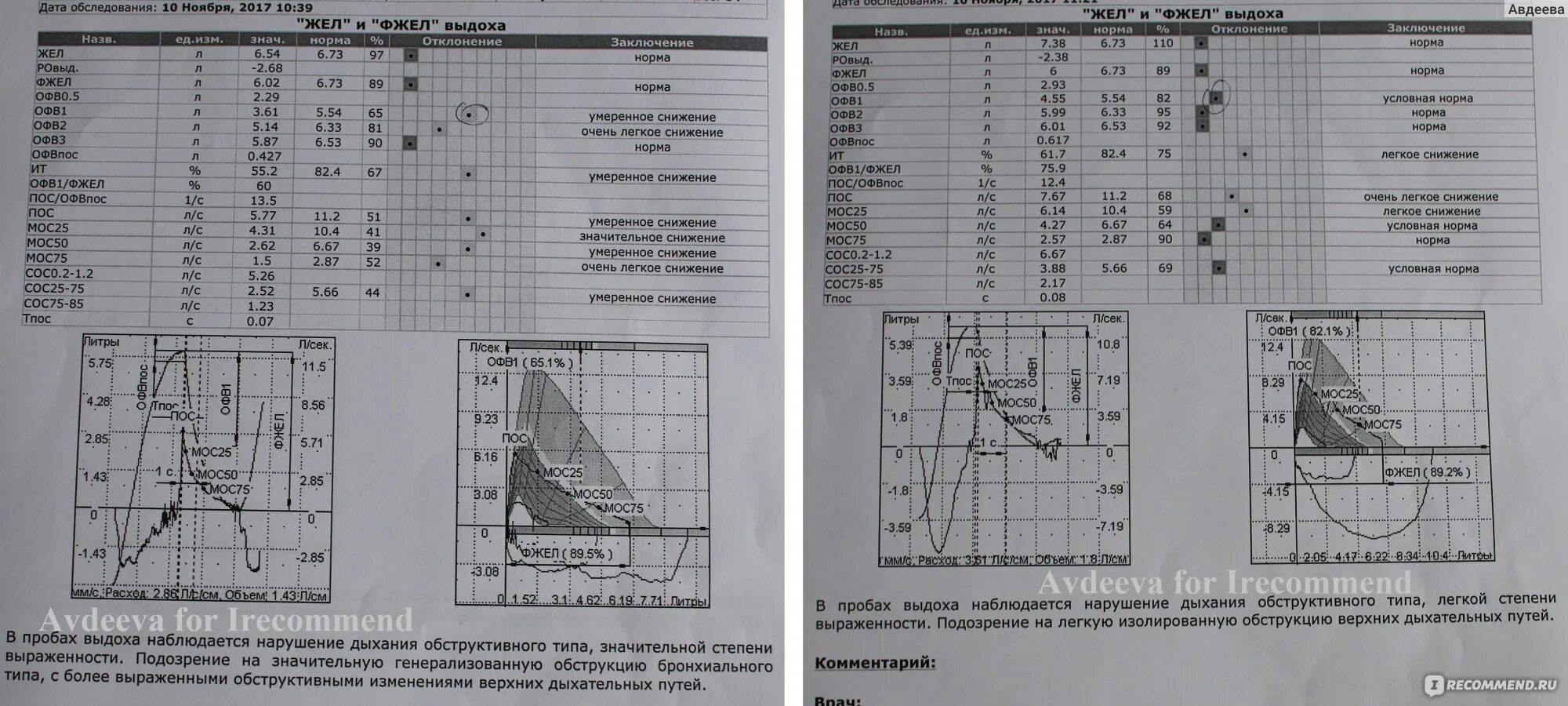 Жел значительно снижена что это. Эмфизема спирограмма. Показатели при спирометрии. Минутный объем дыхания на спирограмме. Спирография при дыхательной недостаточности 1 степени.