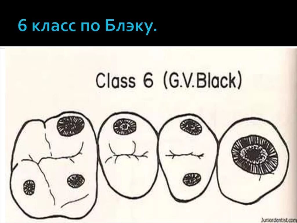 Классы полости рта. Полости 6 класса по Блэку. Классификация кариозных полостей по Блэку 6. Классификация Блэка кариес. Кариозная полость 6 класса по Блэку.