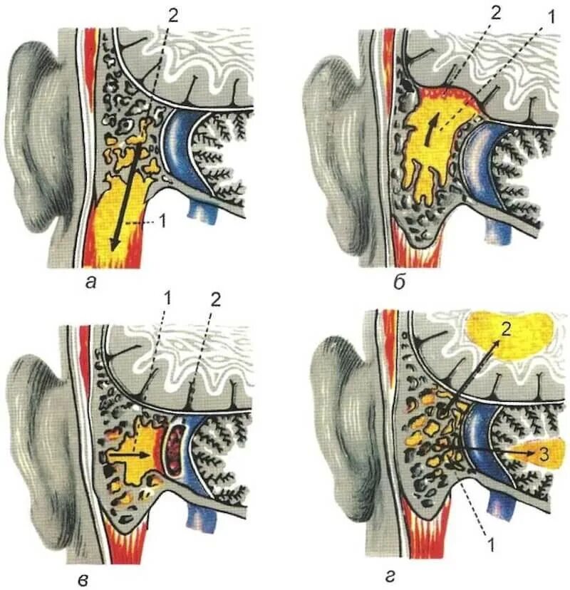 Гнойный мозг. Отогенный экстрадуральный абсцесс. Отогенные абсцессы мозга. Отогенный сепсис.