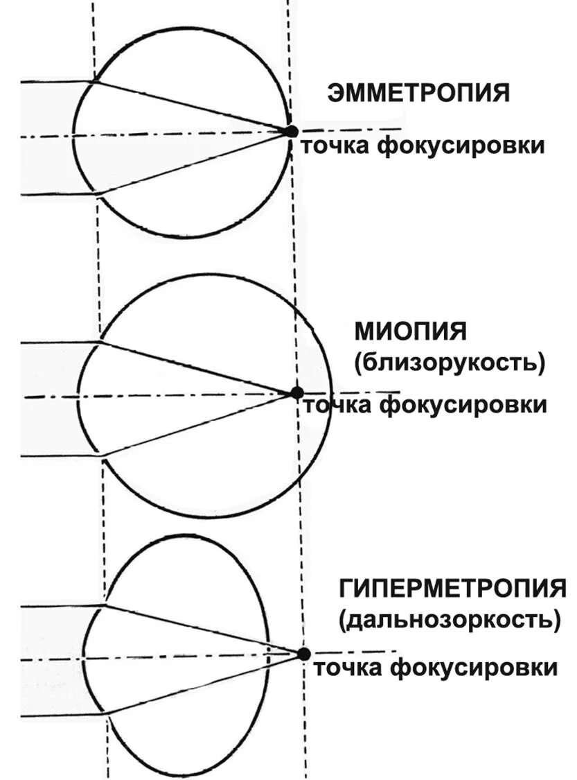 эмметропия глаза что это такое. эмметропическая рефракция. эмметропия миопия. метропичнскпя рефракция. механизм рефракции глаза.