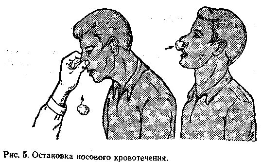 Карта смп носовое кровотечение. Оказание помощи при кровотечении из носа. Остановка носового кровотечения. При кровотечении из носа. Носовое кровотечение картинки.