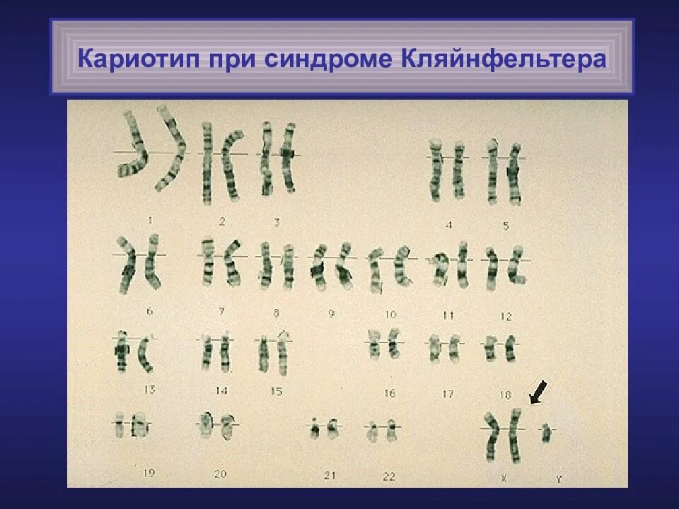 Кариотип человека генетика. Генотип и кариотип гемофилии. гемофилия кариотип больных. кляйнфельтер синдромы кариотип. гемофилия формула кариотипа.