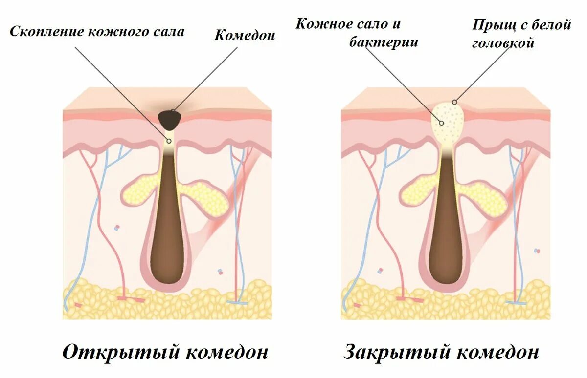 Что сделать чтобы прыщ быстрее прошел