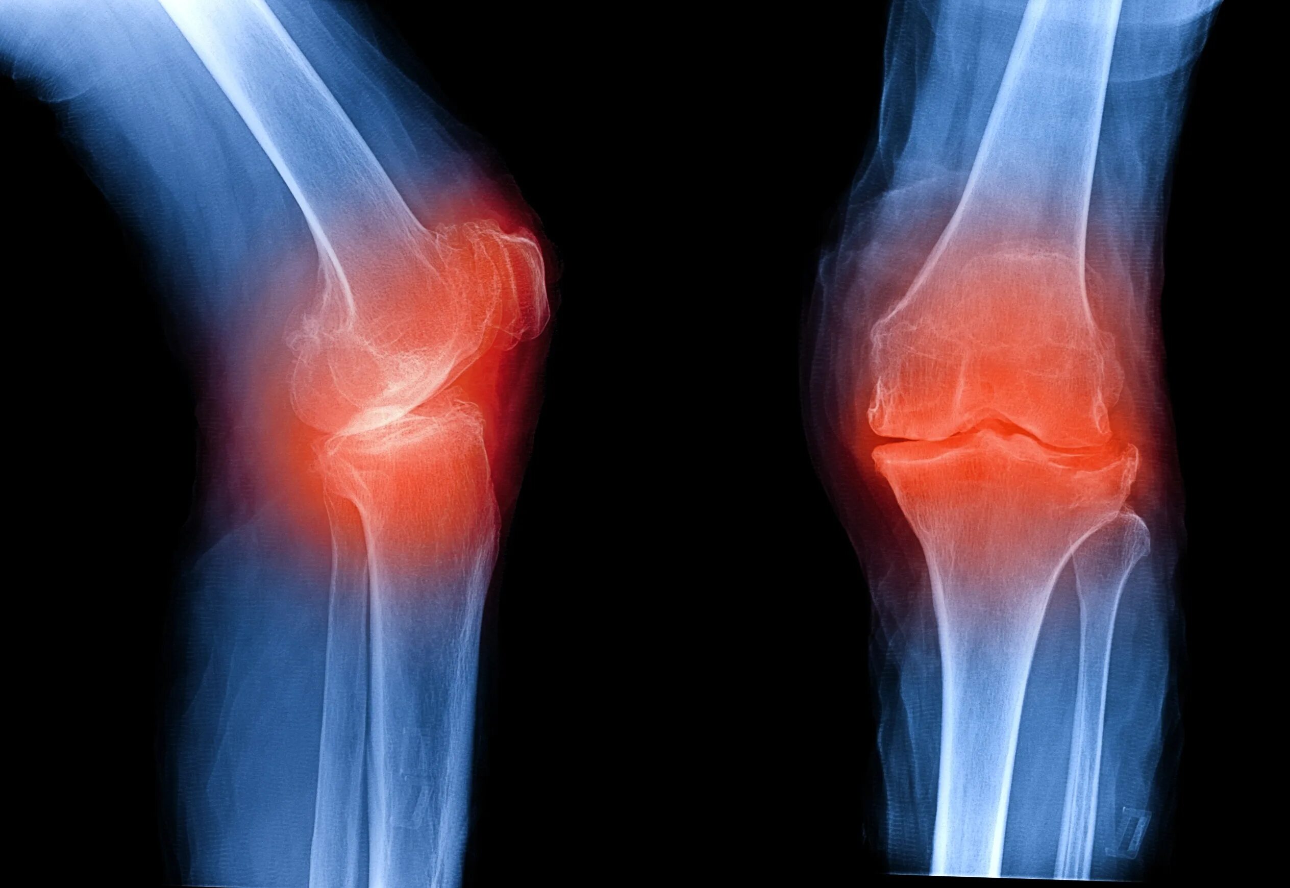 Реактивный синовит коленного сустава. Остеоартроз остеофиты. Остеоартроз коленного сустава рентген. Артроз коленного сустава рентген.