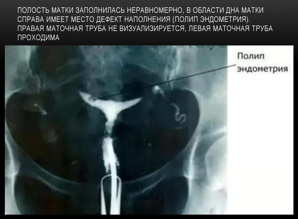 Забеременела при непроходимости труб. Гистеросальпингография непроходимость маточных труб. Гистеросальпингография рентген маточных труб. ГСГ снимки маточных труб непроходимость. ГСГ непроходимость маточных труб.