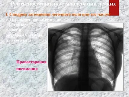 Синдром поле