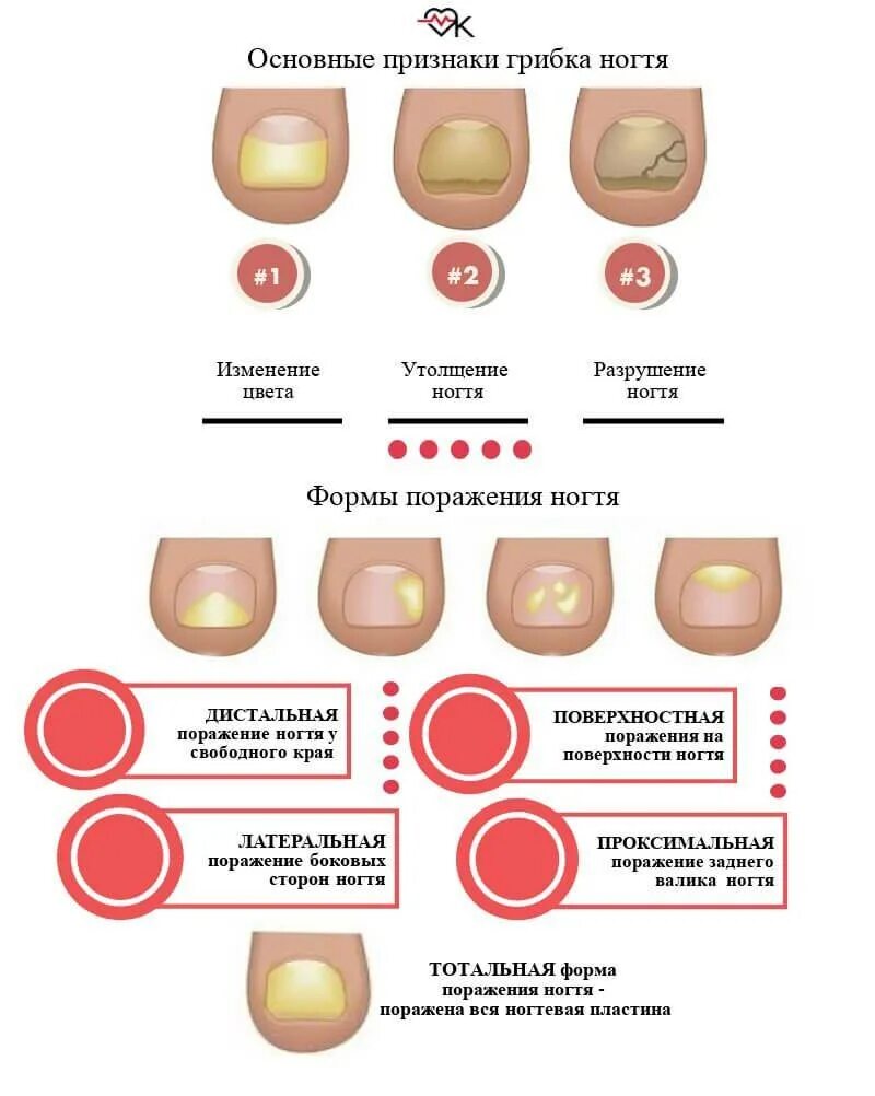 Сдать на какие грибки. Грибковые инфекции ногтей онихомикоз. Симптомы поражения ногтя грибком. Онихомикоз стадии заболевания. Грибковые заболевания ногтей классификация.