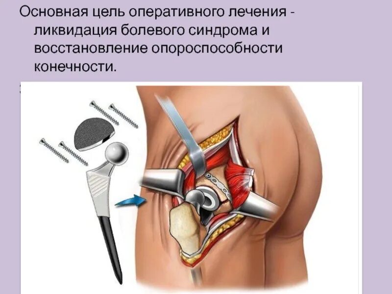 Эндопротезирование тазобедренного отзывы пациентов после операции. Перелом шейки бедра операция эндопротез. операция эндопротез тазобедренный. эндопротезирование тазобедренного сустава техника операции. эндопротез тазобедренного сустава цементной фиксации.