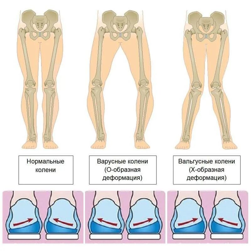 Какие должны быть ноги. Варусная деформация колена. Варусная деформация коленных суставов. Варусная деформация бедра. Варусная деформация конечностей.
