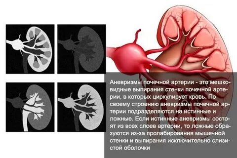 Почечная аневризма