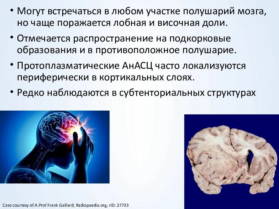 Как проявляется рак мозга. Новообразование в головном мозге симптомы у взрослых. опухоли головного мозга презентация. признаки опухоли головного мозга. критерии злокачественности опухоли головного мозга.