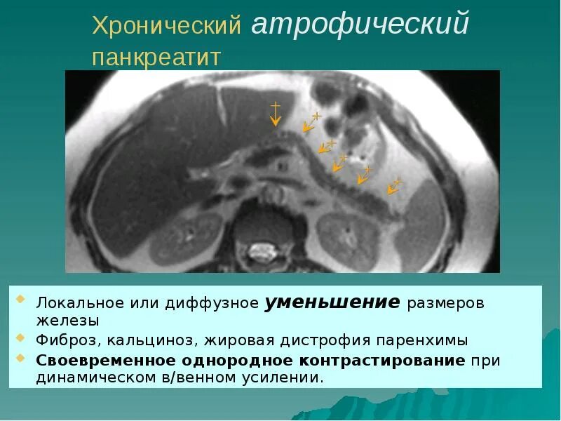 Диффузно дистрофические изменения поджелудочной. Кальцификация поджелудочной железы кт. дистрофия поджелудочной железы кт. жировое образование поджелудочной железы кт. жировая дегенерация поджелудочной железы на кт.