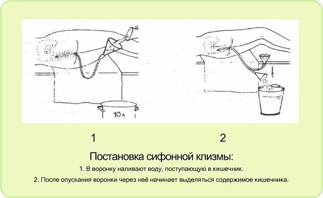 Постановка сифонной клизмы алгоритм. Постановка сифонной клизмы оснащение. Технику постановки сифонной клизмы. Сифонная клизма алгоритм. Очистительная клизма применение