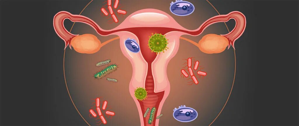 Заболевания репродуктивной системы. Заболевания женской половой системы. Воспалительные заболевания женских.половых органов гинекология. Болезни женской репродуктивной системы. Микроорганизмы женских половых органов