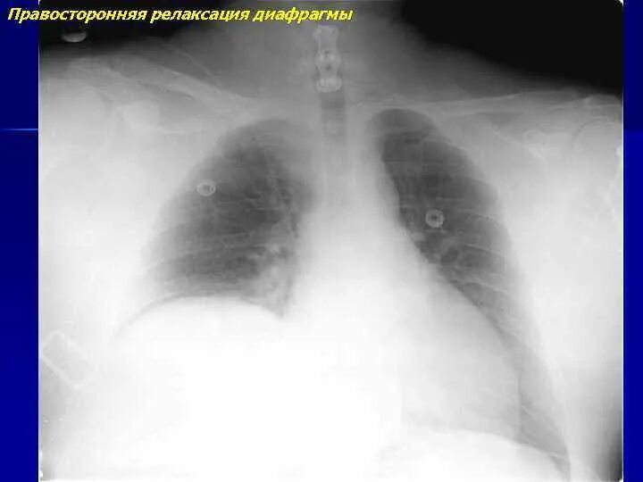 Релаксация купола диафрагмы что это такое. Патология диафрагмы на рентгенограмме. Диафрагмальная грыжа рентген снимок. Купол диафрагмы на рентгенограмме. Релаксация левого купола диафрагмы рентген.
