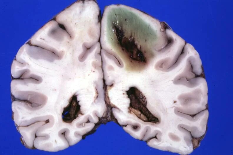Амебный абсцесс головного мозга. Амебный менингоэнцефалит. Метастатические абсцессы головного мозга макропрепарат.
