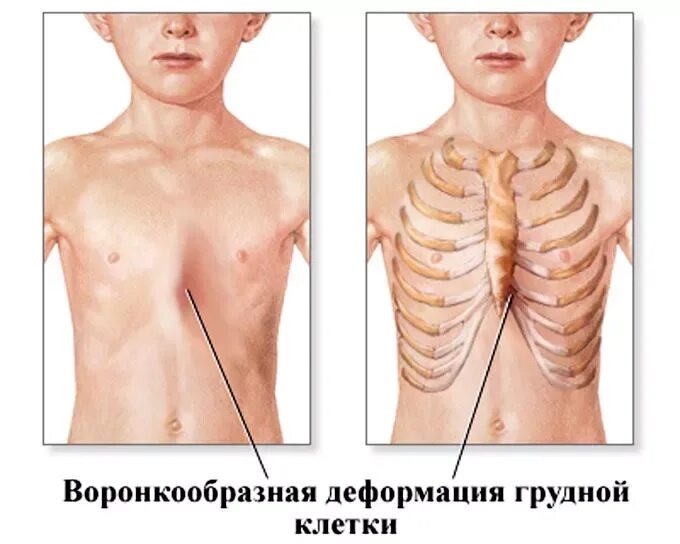 Воронкообразная Грудь Фото