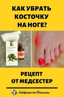 Средство от косточек на ногах