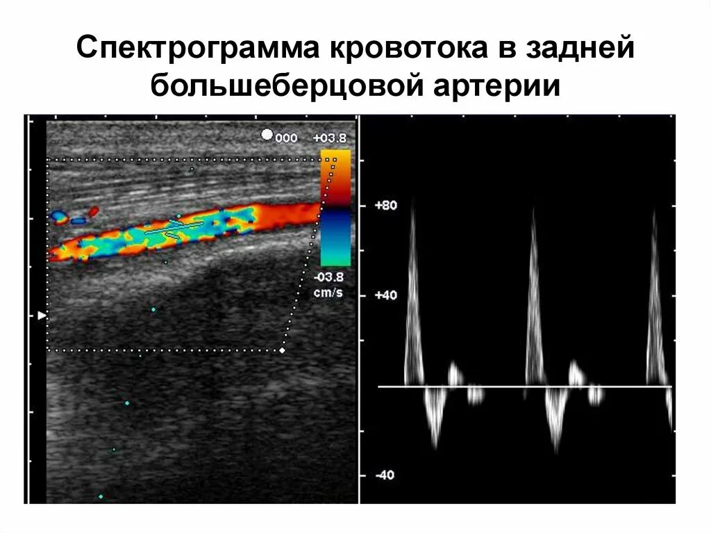 Тип кровотока 1 типа. Типы артериального кровотока на узи. кровоток в артериях нижних конечностей узи. допплерография, спектр кровотока. магистрально измененный тип кровотока на узи.