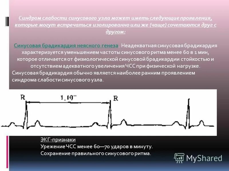 Слабость синусового узла мкб. Синдром слабости синусового узла (СССУ). Дисфункция синусового узла ЭКГ. Брадикардия слабость синусового узла. Синусовая брадикардия характеризуется.