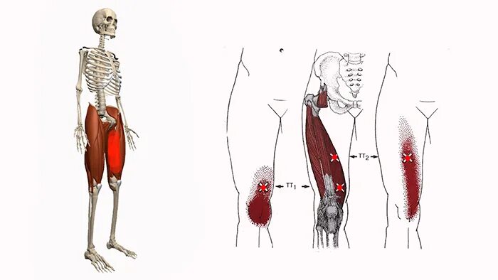 Триггерные точки бедра. Триггерные точки прямой мышцы бедра. Большая приводящая мышца бедра триггерные точки. Триггерная точка передней мышцы бедра. Болит правая нога и отдает в пах